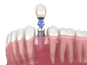 Dental implant terms you should know in New Orleans