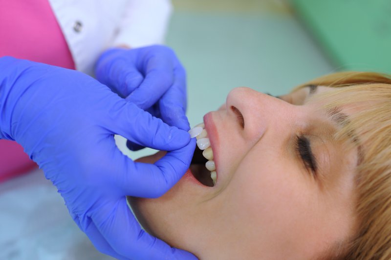 Dentist placing dental veneers on patient's teeth