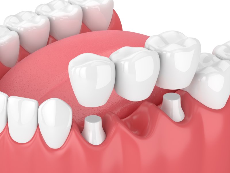 3D illustration of a dental bridge