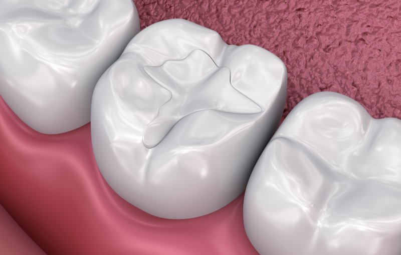 3D illustration of dental fillings