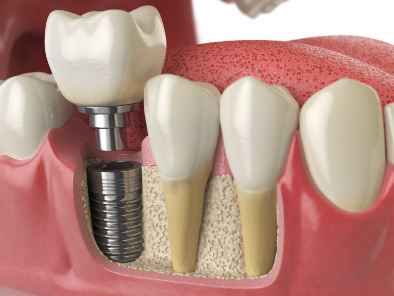 A 3D illustration of a dental implant in New Orleans