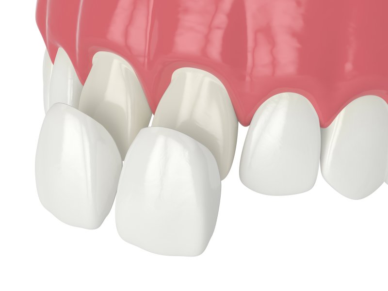 3D illustration of porcelain veneers in New Orleans