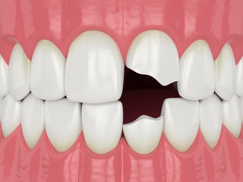 A 3D illustration of a chipped tooth or two