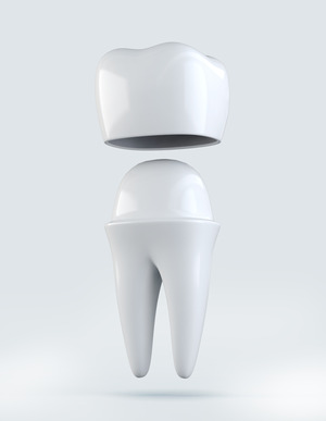 Illustration of a tooth and a metal-free crown